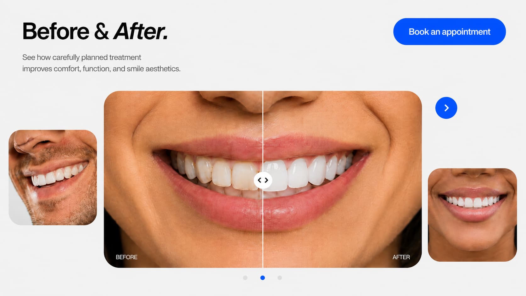 The Smile Co. treatment before and after overview
